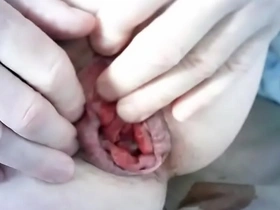 Prolapse rosebud